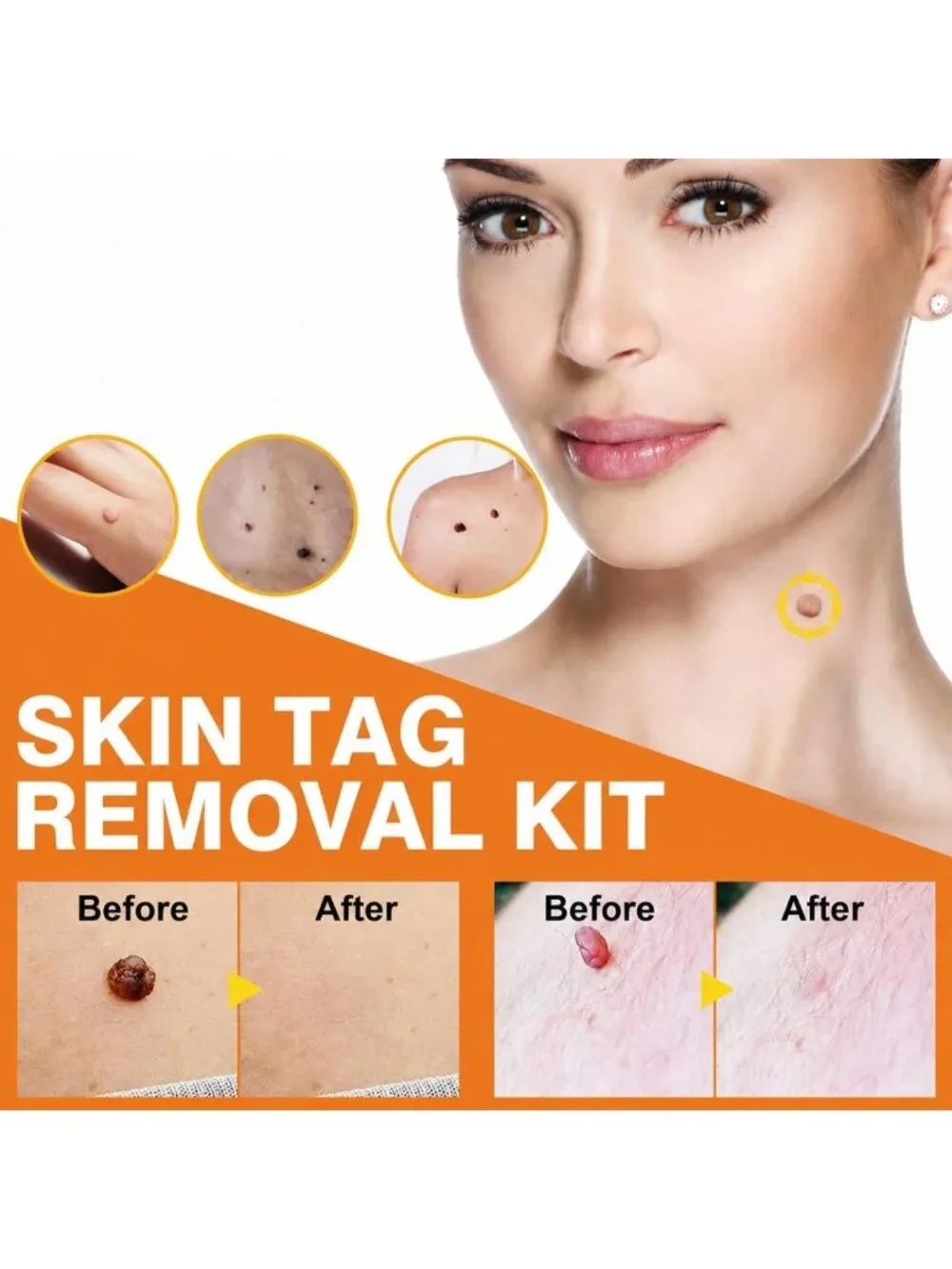 Effective Skin Tag Remover Kit - FDA-Cleared Device for Safe Home Use (Blue)